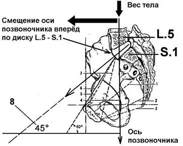Расположение межпозвоночного диска L.5 - S.1 под углом