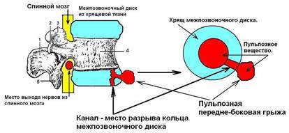 Грыжа из пульпозного вещества межпозвоночного диска