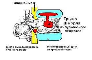 Грыжа Шморля