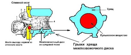 Грыжа из хряща межпозвоночного диска