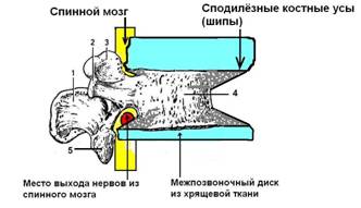 Спондилёзный остеофит (грыжа костная)