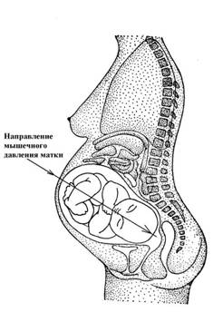 Направление давления мощных мышц матки на позвоночник ребёнка