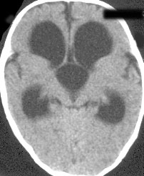 3ventriculomegaly.jpg (17072 bytes)