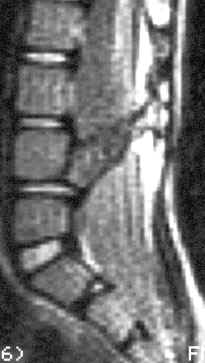 diastematomyelia